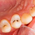 Restoring Damaged or Decayed Teeth: Everything You Need to Know