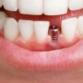 Improving Chewing and Speaking for Dental Implants