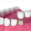 Understanding Dental Bridges: The Key to a Successful Full Mouth Reconstruction