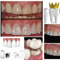All About All-Ceramic Crowns: The Perfect Solution for a Natural-Looking Smile