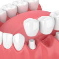 How to Replace Missing Teeth: Understanding the Benefits of Dental Bridges
