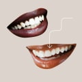 Understanding Veneers: A Guide to Cosmetic Dentistry