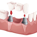 A Step-by-Step Guide to Preparing Abutment Teeth for Dental Bridges