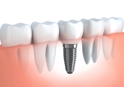 The Importance of an Initial Consultation for Dental Implants