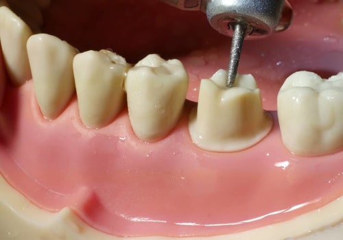 Understanding Tooth Preparation: A Comprehensive Guide to Getting Dental Crowns