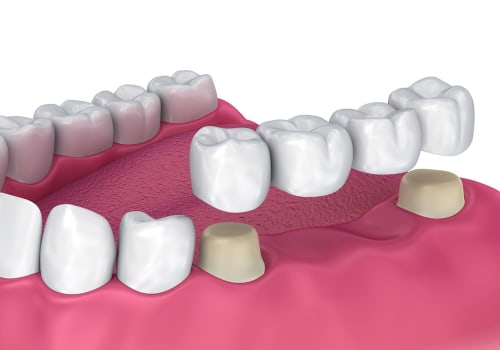 Understanding Dental Bridges: The Key to a Successful Full Mouth Reconstruction