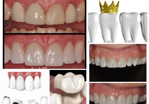 All About All-Ceramic Crowns: The Perfect Solution for a Natural-Looking Smile