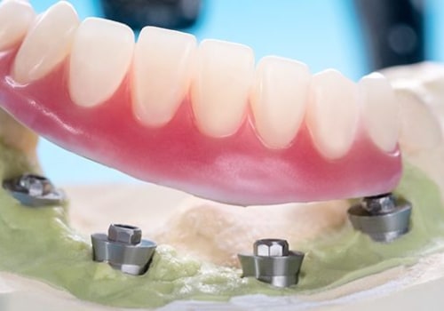 All You Need to Know About Dental Implants