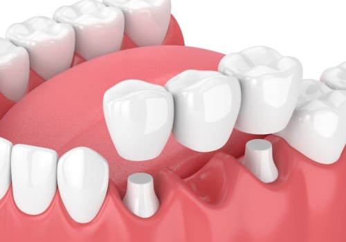 How to Replace Missing Teeth: Understanding the Benefits of Dental Bridges