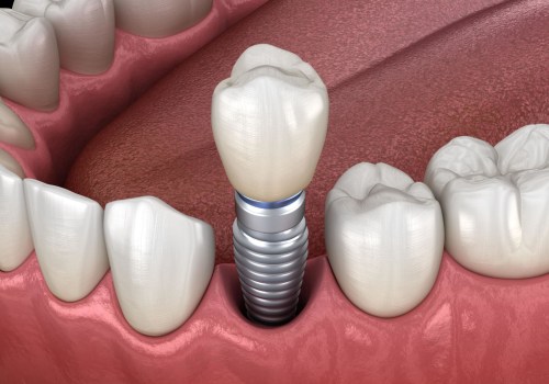 The Ultimate Guide to Long-Term Solutions for Dental Implants