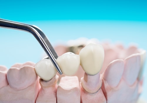 Placement and Adjustment: The Key to Successful Dental Bridges