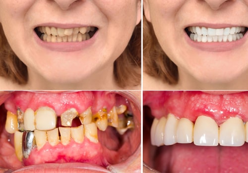 Improving Tooth Appearance: Tips and Benefits for a Brighter Smile